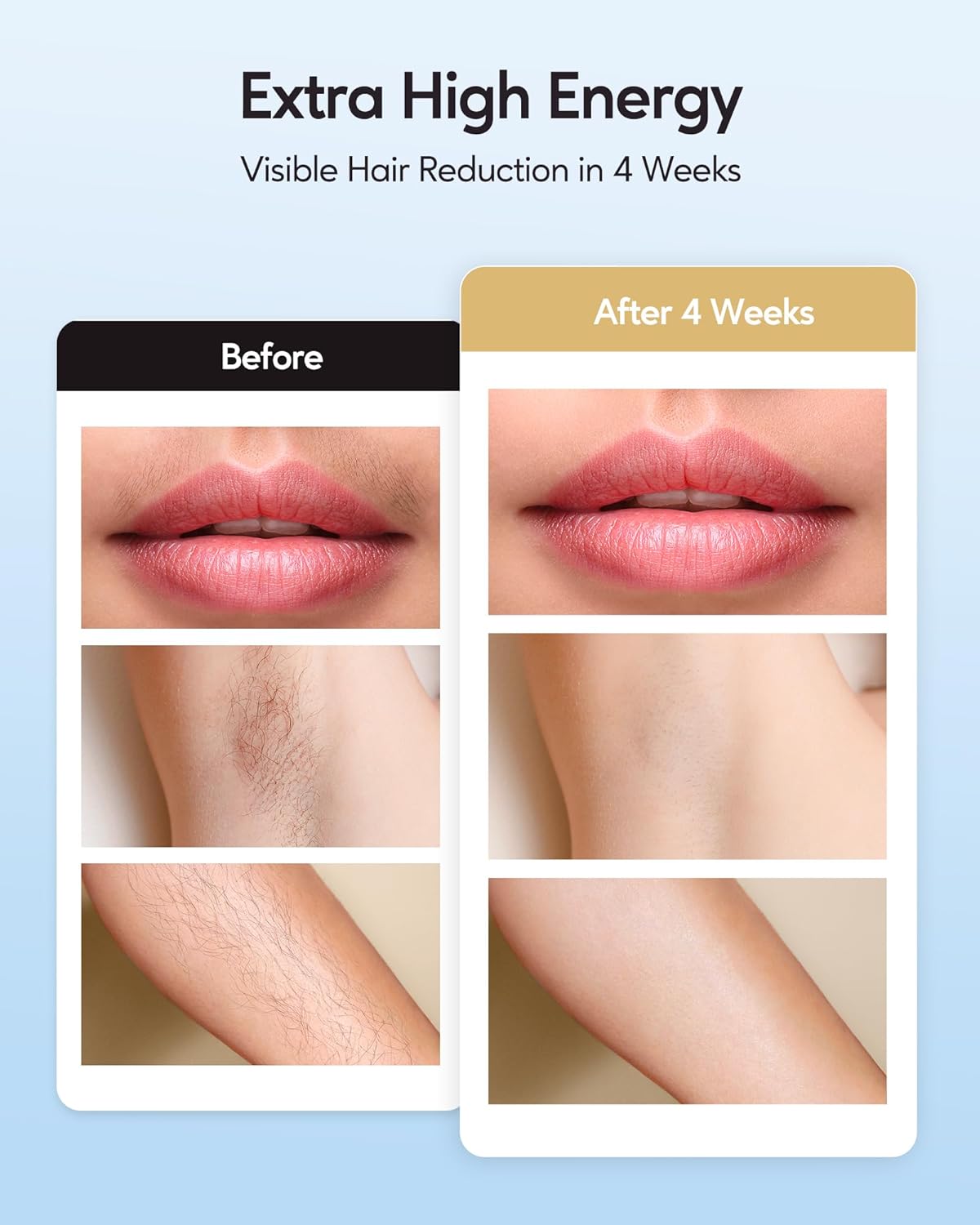 IPL Hair Removal Device
